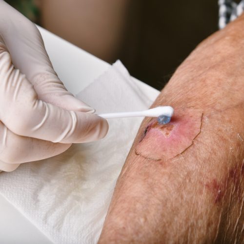 Wound dressing, Doctor applying medicine to infected wound in chronic diabetes senior patient, Accidental wound care treatment in elderly old man.